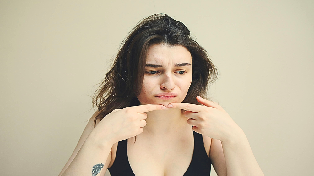 The challenges of puberty: When hormones run wild PART II: About acne