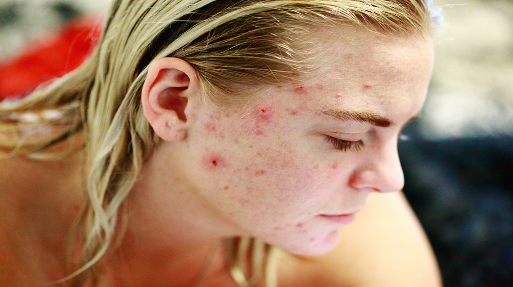 Spots, Acne, and Everyday Skincare – Interview 1 with Vojtěch Hanulík – Microbiologist and Dermatovenereologist